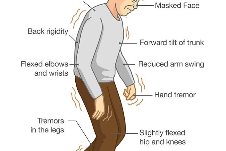 Parkinson's Disease Symptoms