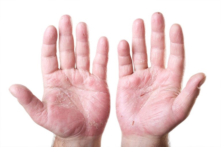 two male palms with eczema isolated two male palms with eczema isolated