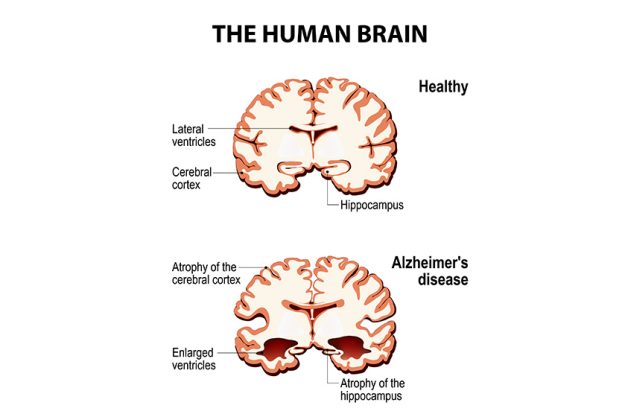 Cross-section of the human brain with Alzheimer’s disease Cross-section of the human brain with Alzheimer's disease