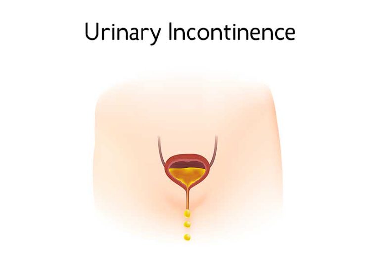 Anatomy picture of Urinary incontinence.