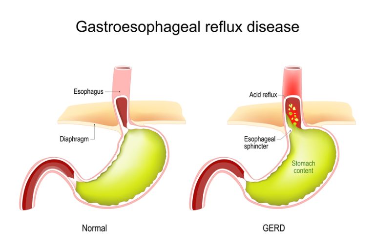 intragastric balloon3 A Guide To GERD Management In Assisted Living Communities In Centreville, VA