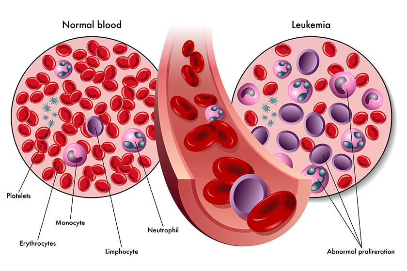 Colorful Leukemia scheme Colorful Leukemia scheme
