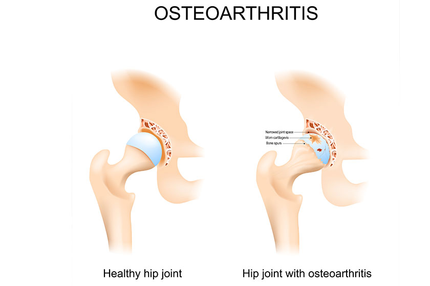 Hip joint with osteoarthritis with femoral head Hip joint with osteoarthritis with femoral head