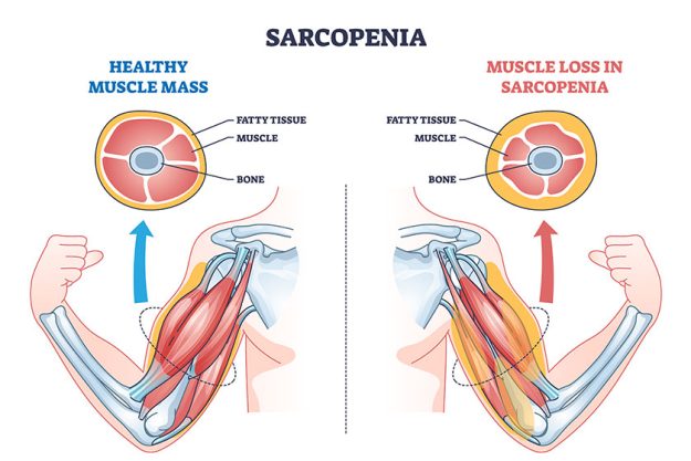 Sarcopenia as muscle mass loss