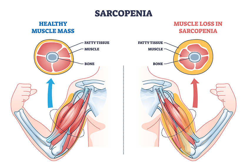 Sarcopenia as muscle mass loss Sarcopenia as muscle mass loss