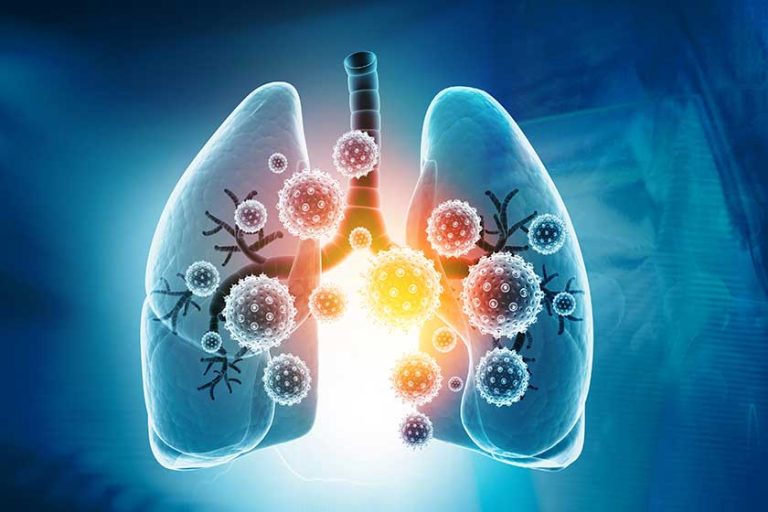 viral lung infections lung infection conept illustration