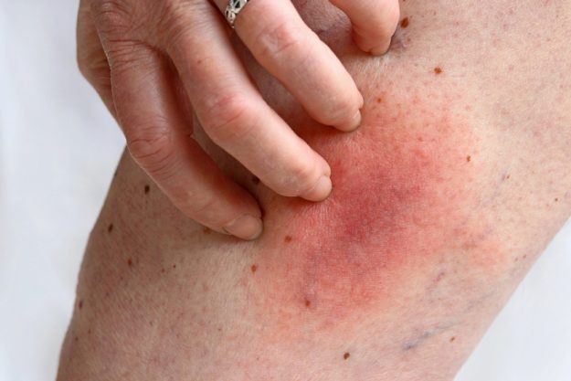 Understanding The Causes Of Itchy Skin After Turning 60 & How To Handle It Understanding The Causes Of Itchy Skin After Turning 60 & How To Handle It