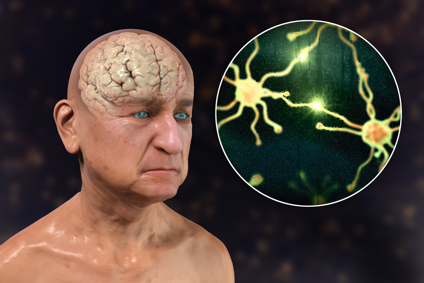 Dementia and Alzheimer’s disease medical concept, 3D illustration Dementia and Alzheimer's disease medical concept, 3D illustration