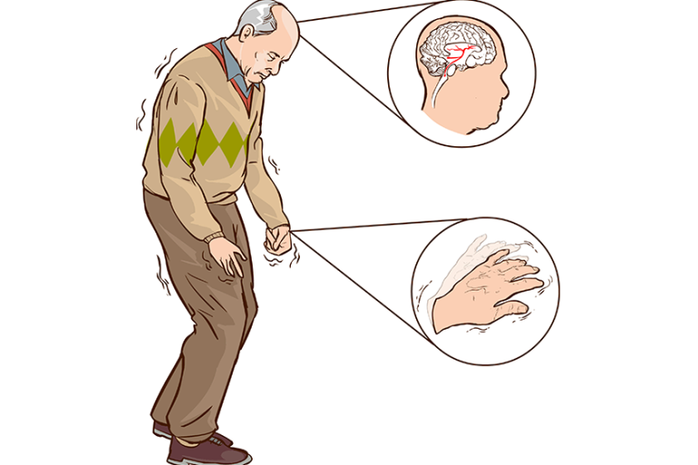 Old man with parkinson symptoms