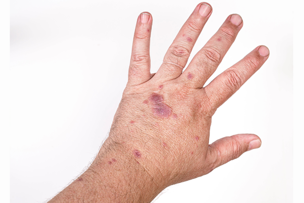 allergic dermatitis skin hands allergic dermatitis skin hands