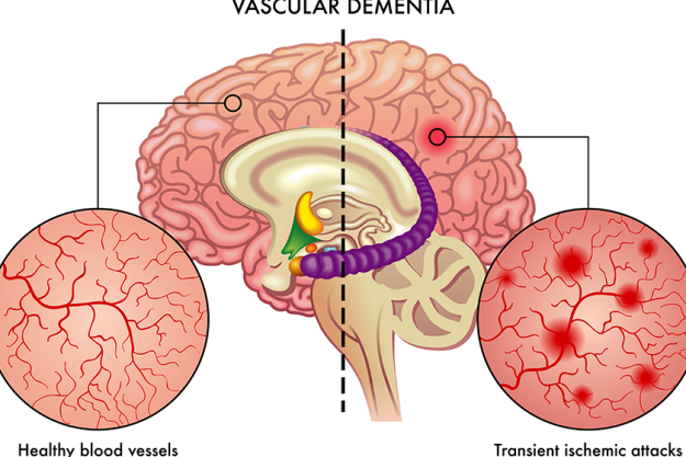 medical illustration compares healthy blood vessels medical illustration compares healthy blood vessels
